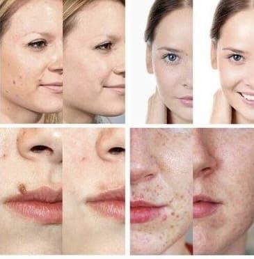 Cauterizador Premium 🔥 Elimina Verrugas, Lunares y Manchas en Minutos + OBSEQUIO